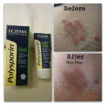 How I Found Eczema Relief #EczemaAndMe 